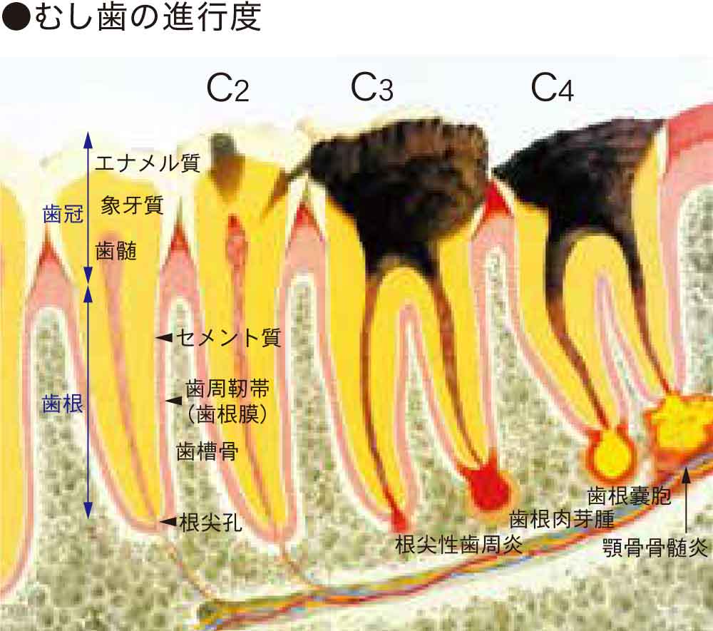 むし歯の進行度